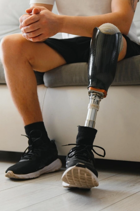 фото пациента после ампутации обратившегося за реабилитацией